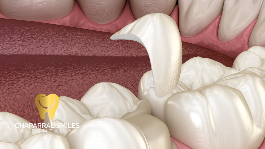 Are Inlays and Onlays Right for You