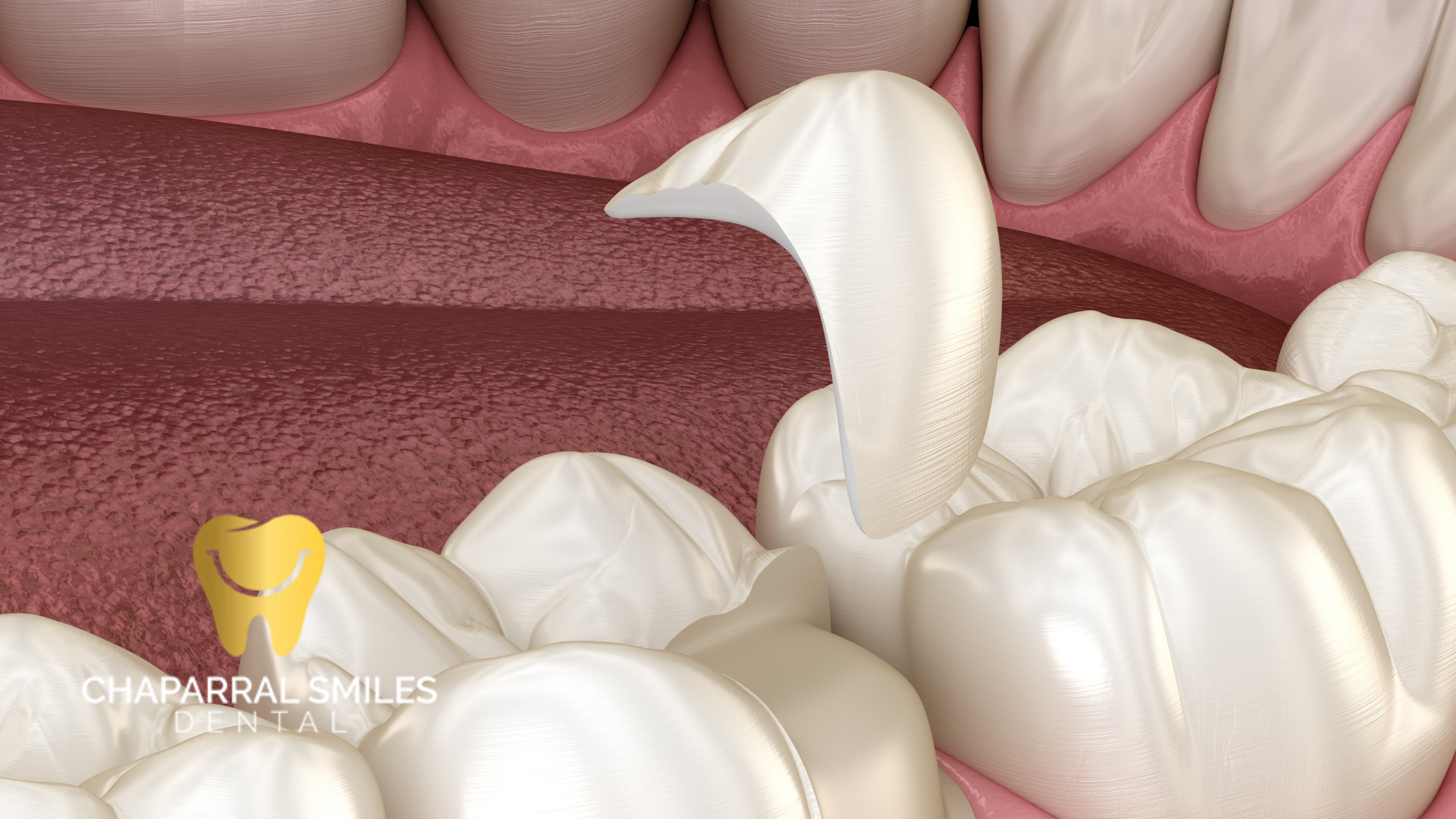 Are Inlays and Onlays Right for You